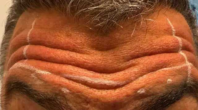 Antes de Toxina Básica