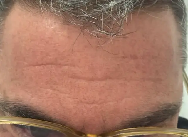 Después de Toxina Básica