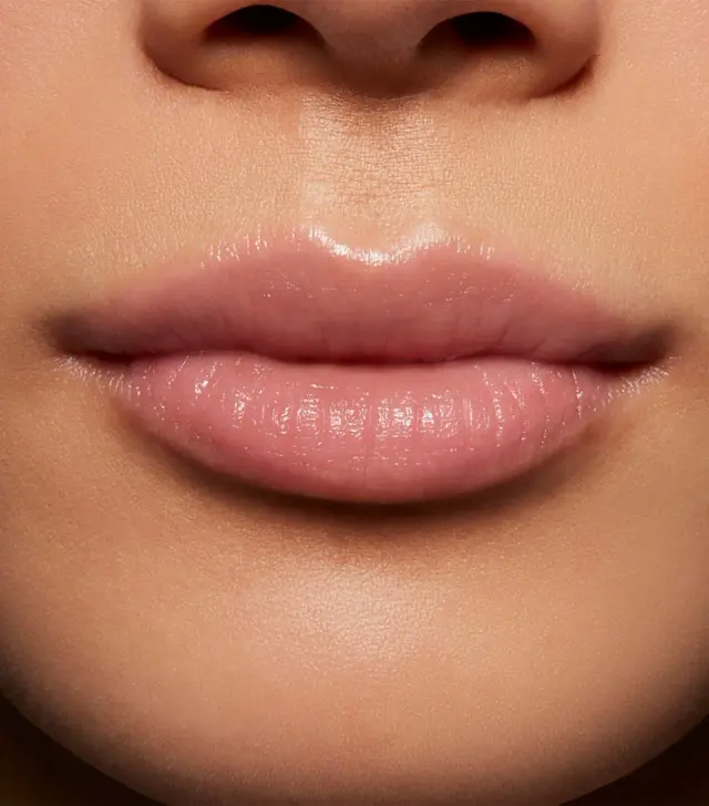 Labio superior fino sin agregar volumen