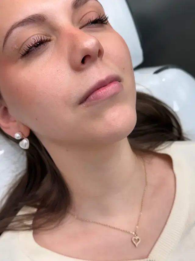 Antes de Relleno y Perfilado Labial
