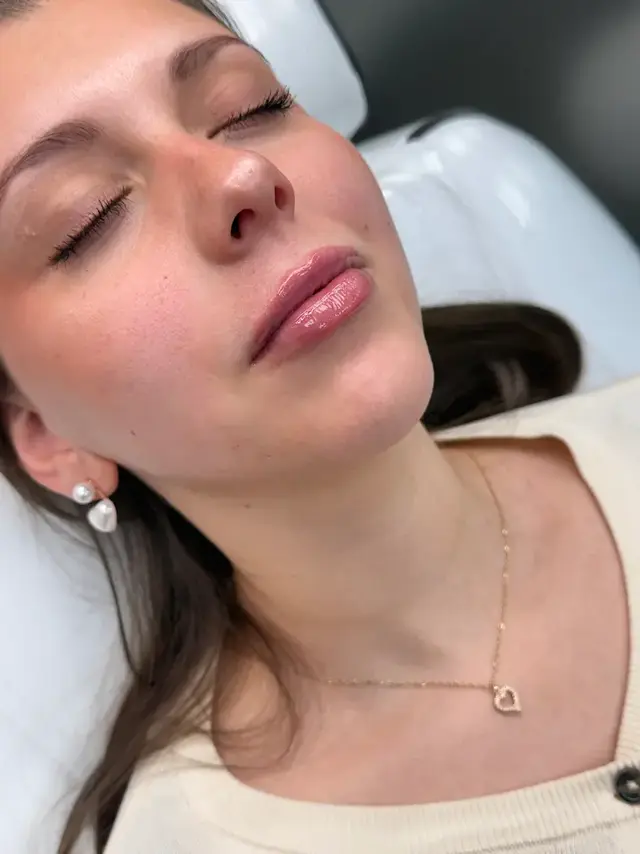 Después de Relleno y Perfilado Labial