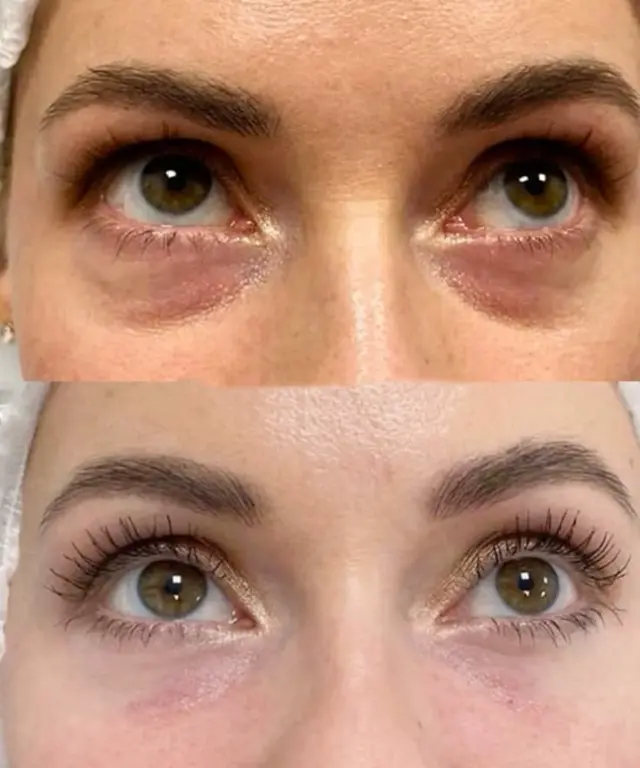 Ojeras y mirada cansada