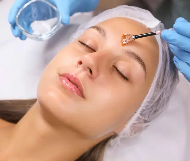 Peeling Químico