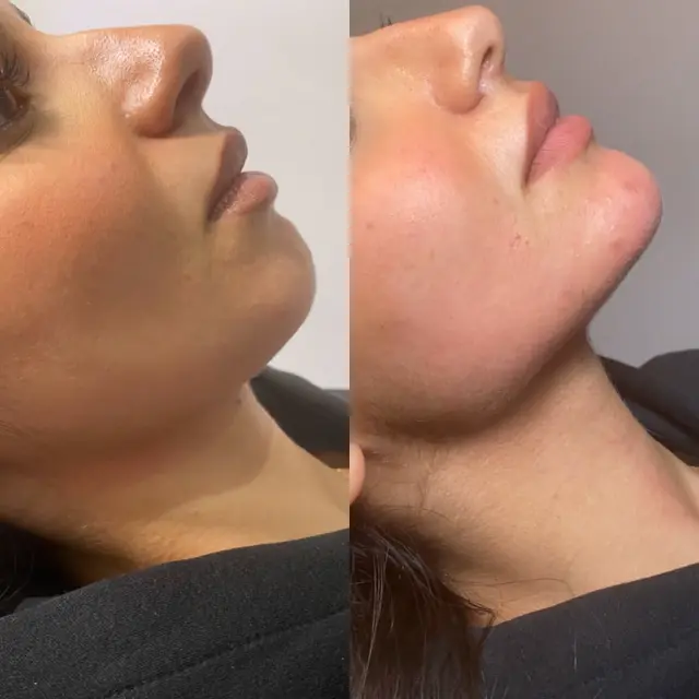 Pérdida de volumen facial