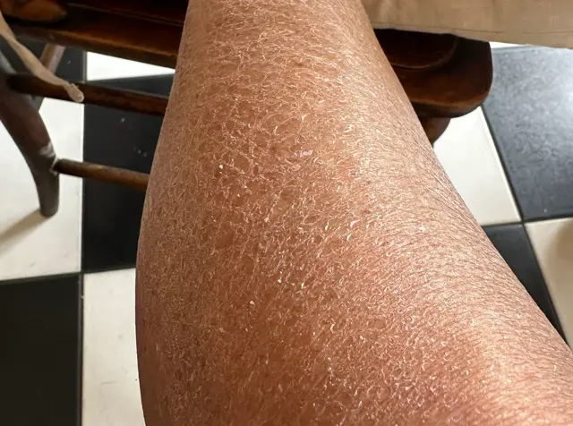 Piel corporal desvitalizada