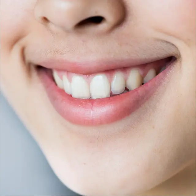 Toxina para Sonrisa Gingival