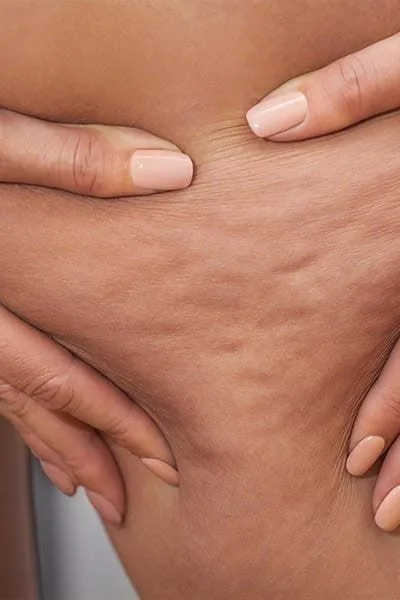Celulitis
