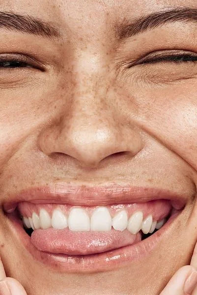 Sonrisa gingival