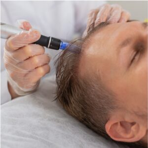 PRP Capilar pack 3 sesiones