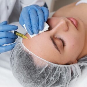 PRP Facial