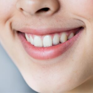 Toxina Sonrisa Gingival