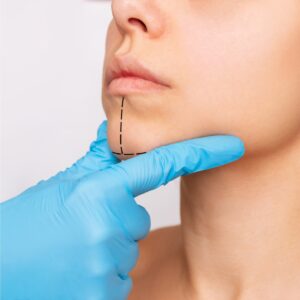 Mentalis (mentón empedrado)